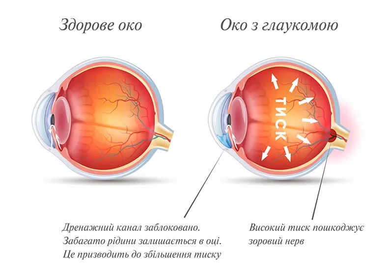 Лікування глаукоми